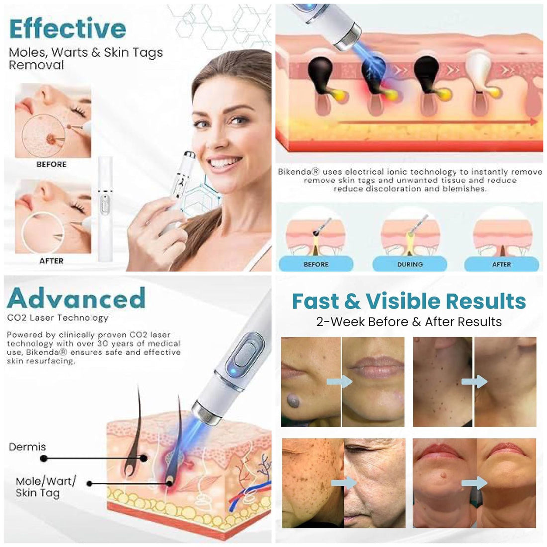 Bikenda CO2 Laser Mole, Wart &amp; Skin Tag Remover Pen